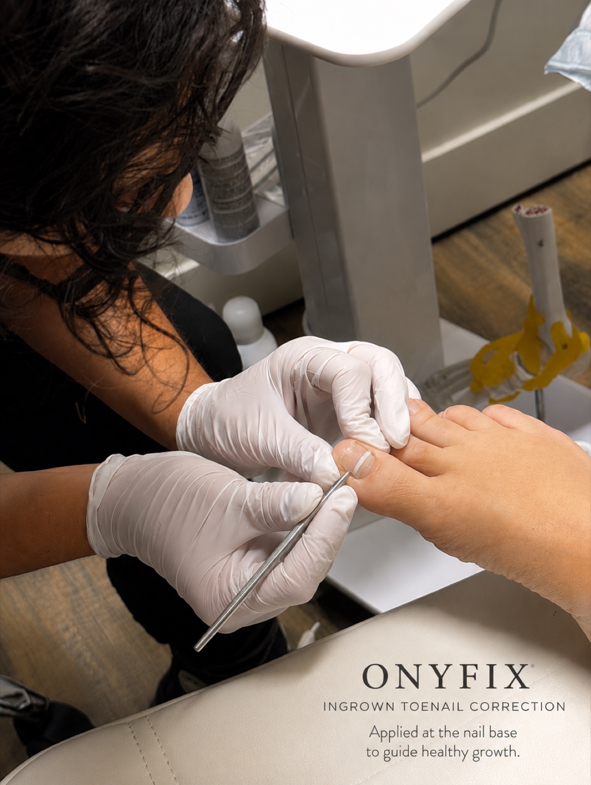 OnyFix Ingrown Toenail Correction — Salmon Arm Aesthetics